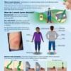 Lyme disease is one of the bacterial infections spread to humans by infected tic...